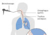 Definition, symptoms, causes and Treatment for Mesothelioma pain in side -mesothelioma definition mesothelioma definition