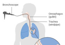 Definition, symptoms, causes and Treatment for Mesothelioma pain in side -mesothelioma definition mesothelioma definition