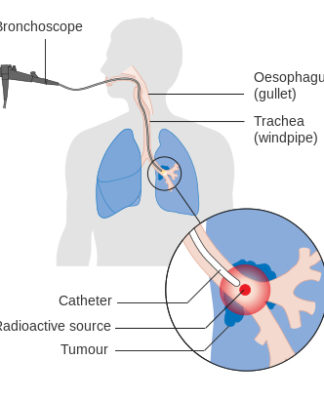 Definition, symptoms, causes and Treatment for Mesothelioma pain in side -mesothelioma definition mesothelioma definition