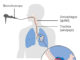 Definition, symptoms, causes and Treatment for Mesothelioma pain in side -mesothelioma definition mesothelioma definition