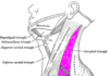 Cystic Hygroma