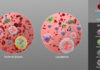 acute lymphoblastic leukemia